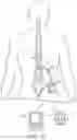 Fig. 04 - Bulkhead anchor for medical device leads