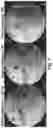 Fig. 08 - MAGNETIC STIMULATION OF THE SPINAL CORD TO RESTORE CONTROL OF BLADDER AND/OR BOWEL