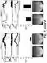Fig. 09 - MAGNETIC STIMULATION OF THE SPINAL CORD TO RESTORE CONTROL OF BLADDER AND/OR BOWEL