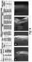 Fig. 10 - MAGNETIC STIMULATION OF THE SPINAL CORD TO RESTORE CONTROL OF BLADDER AND/OR BOWEL