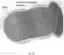 Fig. 32 - Methods and devices for treating vascular related disorders