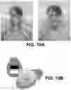 Fig. 12 - THERMISTOR BASED RESPIRATION MEASUREMENT