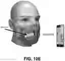 Fig. 14 - THERMISTOR BASED RESPIRATION MEASUREMENT