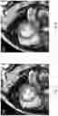 Fig. 05 - SLICE ALIGNMENT FOR SHORT AXIS CARDIAC MR CINE SLICE STACKS