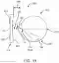 Fig. 02 - Methods for the treatment of refractive error using active stimulation