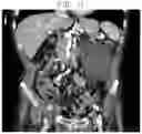 Fig. 10 - METHOD AND SYSTEM OF STATISTICAL IMAGE RESTORATION FOR LOW-DOSE CT IMAGE USING DEEP LEARNING
