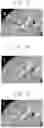 Fig. 12 - METHOD AND SYSTEM OF STATISTICAL IMAGE RESTORATION FOR LOW-DOSE CT IMAGE USING DEEP LEARNING