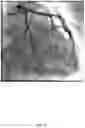 Fig. 32 - Method and system for calculating myocardial infarction likelihood based on lesion wall shear stress descriptors