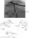 Fig. 34 - Method and system for calculating myocardial infarction likelihood based on lesion wall shear stress descriptors