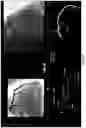 Fig. 37 - Method and system for calculating myocardial infarction likelihood based on lesion wall shear stress descriptors