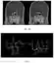 Fig. 08 - Recognition method of intracranial vascular lesions based on transfer learning