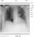 Fig. 12 - System and method for visualizing placement of a medical tube or line