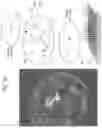 Fig. 19 - Tissue analysis by mass spectrometry or ion mobility spectrometry
