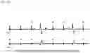 Fig. 08 - ELECTROCARDIOGRAM WAVEFORM ANALYSIS APPARATUS