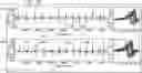 Fig. 01 - Method and system to detect P-waves in cardiac arrhythmic patterns