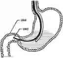 Fig. 01 - Devices and methods to measure gastric residual volume