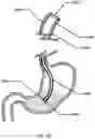 Fig. 16 - Devices and methods to measure gastric residual volume