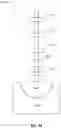 Fig. 25 - Invasive sense measurement in prosthesis installation and bone preparation