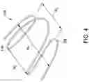 Fig. 05 - MEDICAL DEVICE FOR CLOSURE OF A VASCULAR ABNORMALITY