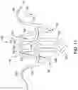 Fig. 11 - MEDICAL DEVICE FOR CLOSURE OF A VASCULAR ABNORMALITY