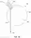 Fig. 17 - MEDICAL DEVICE FOR CLOSURE OF A VASCULAR ABNORMALITY