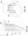 Fig. 30 - MEDICAL DEVICE FOR CLOSURE OF A VASCULAR ABNORMALITY