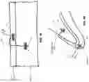 Fig. 53 - METHOD AND APPARATUS FOR CLOSING A FISSURE IN THE ANNULUS OF AN INTERVERTEBRAL DISC, AND/OR FOR EFFECTING OTHER ANATOMICAL REPAIRS AND/OR FIXATIONS