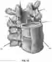 Fig. 61 - METHOD AND APPARATUS FOR CLOSING A FISSURE IN THE ANNULUS OF AN INTERVERTEBRAL DISC, AND/OR FOR EFFECTING OTHER ANATOMICAL REPAIRS AND/OR FIXATIONS
