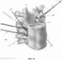Fig. 68 - METHOD AND APPARATUS FOR CLOSING A FISSURE IN THE ANNULUS OF AN INTERVERTEBRAL DISC, AND/OR FOR EFFECTING OTHER ANATOMICAL REPAIRS AND/OR FIXATIONS