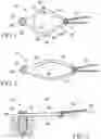 Fig. 02 - Dynamic tensioning devices for orthopedic compression