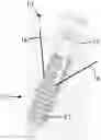 Fig. 01 - Re-tensionable suture anchor system and related methods