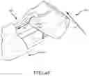 Fig. 13 - Left atrial appendage treatment systems and methods