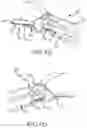 Fig. 18 - Left atrial appendage treatment systems and methods