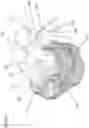 Fig. 15 - Patient-specific guide for total prosthetic knee revision