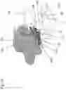 Fig. 17 - Patient-specific guide for total prosthetic knee revision