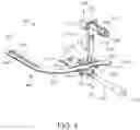 Fig. 02 - Alignment instruments and methods for use in total ankle replacement