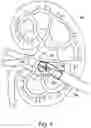Fig. 10 - DILATION AND STONE RETRIEVAL CATHETER