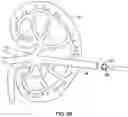 Fig. 12 - DILATION AND STONE RETRIEVAL CATHETER