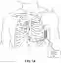 Fig. 02 - MEDICAL TOOLS FOR AND METHODS OF GAINING ACCESS TO EXTRAVASCULAR SPACES