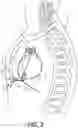Fig. 04 - MEDICAL TOOLS FOR AND METHODS OF GAINING ACCESS TO EXTRAVASCULAR SPACES