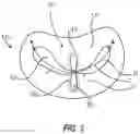 Fig. 04 - SYSTEMS, APPARATUSES, AND METHODS FOR REMOVING A MEDICAL IMPLANT FROM CARDIAC TISSUE