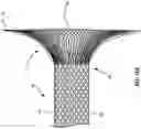 Fig. 14 - SYSTEMS, APPARATUSES, AND METHODS FOR REMOVING A MEDICAL IMPLANT FROM CARDIAC TISSUE