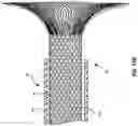 Fig. 15 - SYSTEMS, APPARATUSES, AND METHODS FOR REMOVING A MEDICAL IMPLANT FROM CARDIAC TISSUE