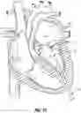 Fig. 21 - SYSTEMS, APPARATUSES, AND METHODS FOR REMOVING A MEDICAL IMPLANT FROM CARDIAC TISSUE