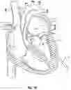 Fig. 22 - SYSTEMS, APPARATUSES, AND METHODS FOR REMOVING A MEDICAL IMPLANT FROM CARDIAC TISSUE