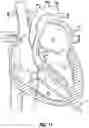 Fig. 23 - SYSTEMS, APPARATUSES, AND METHODS FOR REMOVING A MEDICAL IMPLANT FROM CARDIAC TISSUE