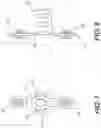 Fig. 06 - Expandable spinal fixation system