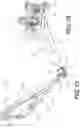 Fig. 11 - Expandable spinal fixation system