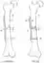 Fig. 23 - Methods and devices for intracorporeal bonding of implants with thermal energy