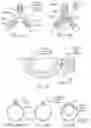 Fig. 65 - Methods and devices for intracorporeal bonding of implants with thermal energy